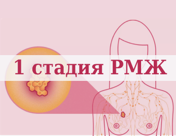 Первая стадия рака молочной железы