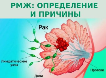 Рак молочной железы (РМЖ): определение и причины