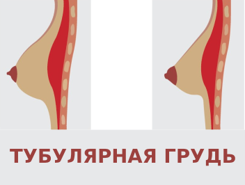 Увеличение и коррекция тубулярной молочной железы