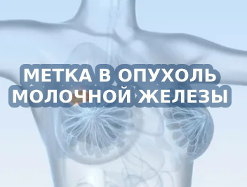 Метка в опухоль молочной железы