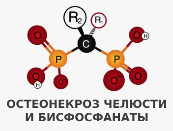 Остеонекроз челюсти при приеме золедроновой кислоты.