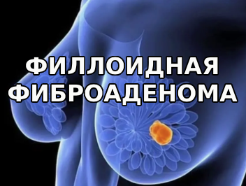 Филлоидная (листовидная) фиброаденома