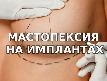 Мастопексия с установкой грудных имплантов