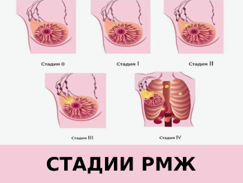 Как определяют стадии рака молочной железы по классификации TNM?