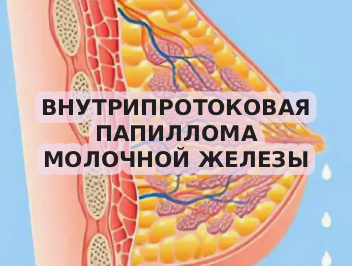 Внутрипротоковая папиллома молочной железы - симптомы и лечение