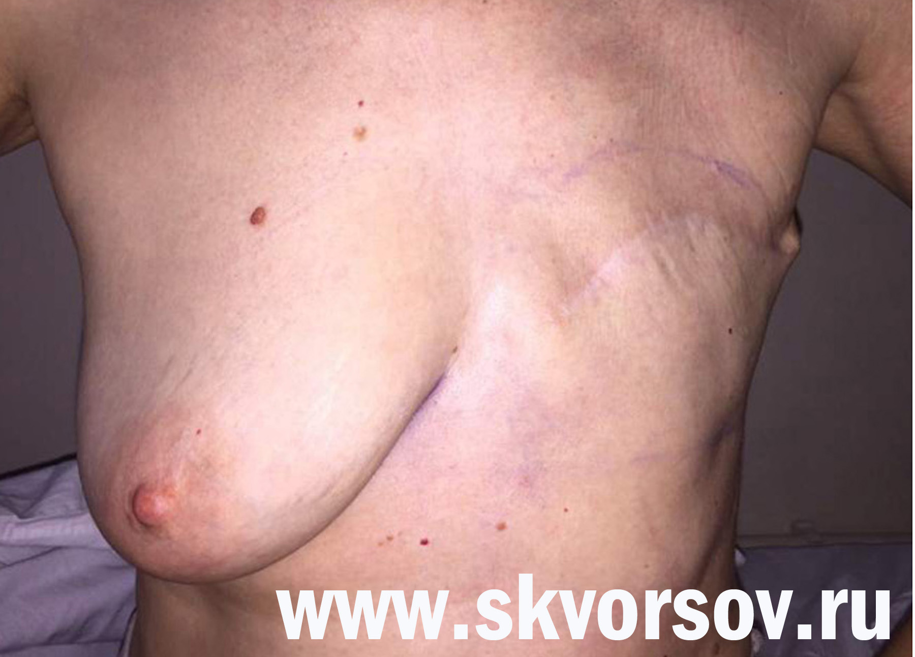 операция по удалению груди у женщин фото 5
